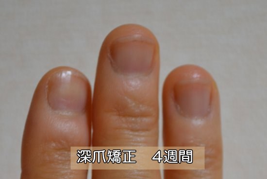 深爪 爪噛み克服４週間 ネイルサロン初日 深爪 爪を噛む癖の治し方矯正 Com
