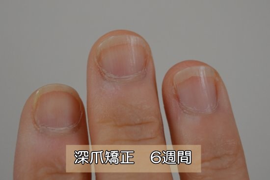 爪噛み 深爪克服６週間目 深爪 爪を噛む癖の治し方矯正 Com