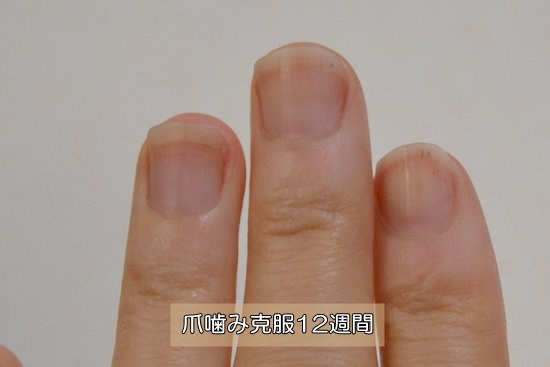 爪噛み克服１２週間目 深爪 爪を噛む癖の治し方矯正 Com
