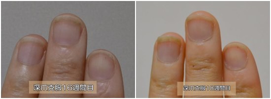 １８週間目と１５週間目の爪の比較